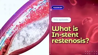 What is In-stent restenosis?