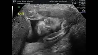 Sonogram 082323