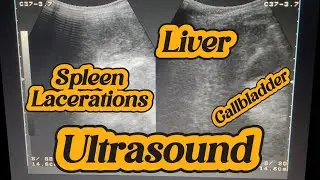 How to Ultrasound Splenic rupture| Trauma Ultrasound Abdomen | Ascites | Spleen Laceration