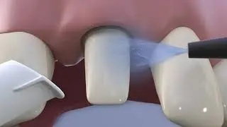 Astringent paste for temporary widening and dry gingival sulcus - VOCO Retraction Paste