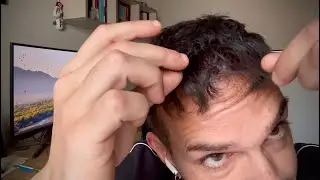 Quando il TRAPIANTO di CAPELLI va male | Cause + la mia esperienza dopo 2 anni e mezzo