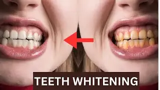 Professional Teeth Whitening: Everything You Need to Know!