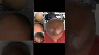 #scalpmicropigmentation #hairlosstreatment #smp #bald #hairlosssolution #hairlosscure #tattoo