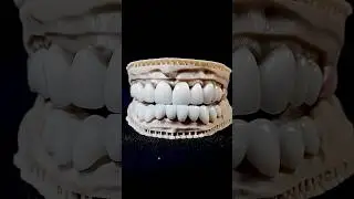 Real Patient's Life-Changing Dental Crown Experience #dentalcrowns #dentist