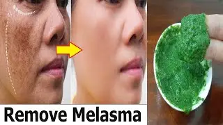 Tips To Eliminate Melasma and Dark Spots 0n The Skin With a Hanful Of Katuk