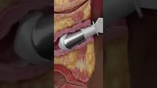 VTone: Non-Invasive Pelvic Floor Strengthening for Women&rsquo;s Wellness