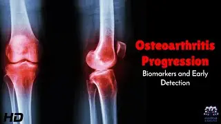 Osteoarthritis Progression: Biomarkers and Early Detection Explained