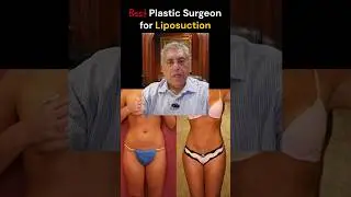 How to get best plastic surgeon for Liposuction in Los Angeles. #bestplasticsurgeon #plasticsurgeon