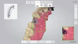 Trios implant restoration workflow