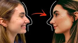 RINOPLASTIA ULTRASSÔNICA