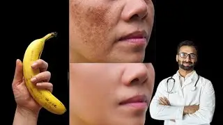 इससे मेरी 13 साल पुरानी झाइयां खत्म हो कर चेहरा गोरा हो गया,REMOVE PIGMENTATION,