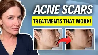 Do This for Acne Scars!