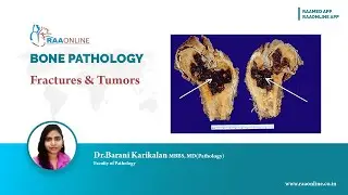 Bone Pathology Fractures and Tumors #BonePathology #Fractures #Tumors