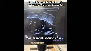 Ultrasound guided IV cannulated the Cephalic Vein in less than a minute. www.masteryivultrasound.com