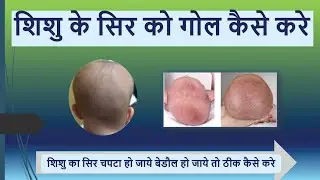 शिशु के सिर को गोल कैसे करे | शिशु  का सिर चपटा हो जाये बेडौल हो जाये तो ठीक कैसे करे