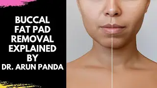 Buccal Fat Pad Removal Explained by Dr. Arun Panda in English