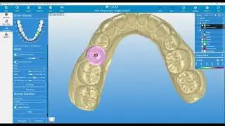 Custom Abutment Design in RealGUIDE