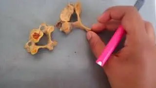 7th CERVICAL VERTEBRA spotting in easy way