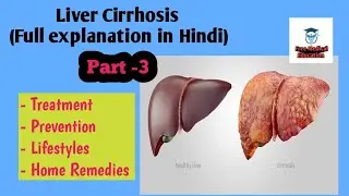 Liver Cirrhosis,Part-3 full explanation in Hindi(Treatment, Prevention, Lifestyles, Home Remedies)