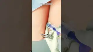 Piles Treatment 3D Animation (PPH Procedure)