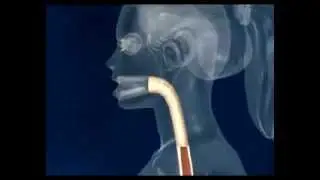Gastric Balloon Explained - Livlife Hospitals