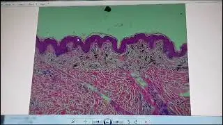 Ashy dermatosis histopathology by Dr. Yosra Abdel Galeil MD IDPD