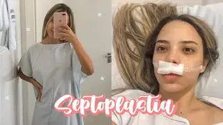 VLOG: MINHA CIRURGIA DE DESVIO DE SEPTO - SEPTOPLASTIA