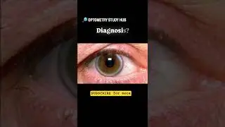 clinical Optometry cases #clinicaloptometry #clinicalophthalmology #oculardisease #arcussenilis #1m