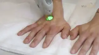 Tratamiento para manchas en las manos en Medsthetik