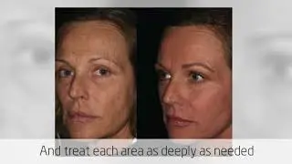 Artful Awakenings Cosmetic Surgery Center - Erbium Laser Resurfacing