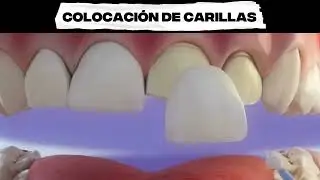 ¿Son las carillas el secreto para una sonrisa perfecta en solo unas pocas visitas?