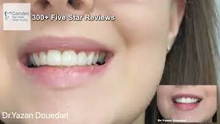 Cosmetic Bonding London | Camden High Street Dental | Fix Your Smile Today!
