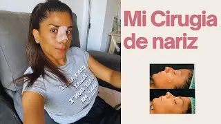 Septorrinoplastia Ultrasonica- Mi experiencia. Part 1