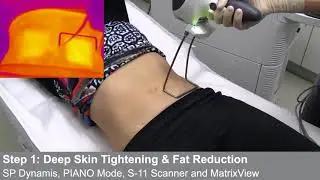TightSculpting® - How It Works