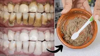 🦷 Натуральная смесь для отбеливания желтых зубов в домашних условиях за 1 день. 🔥