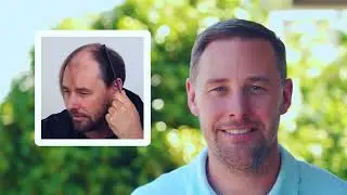Advanced Hair Restoration Amazing Results - Best FUE Hair Transplant Clinic
