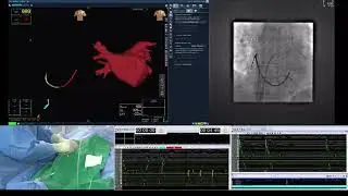AF Ablation/ #4  ICE exam and LA angiogram