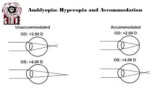 Ocular Disease and Refractive Error Spotlight: Amblyopia