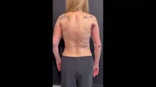 AMAZING BACK LIFT & ARM LIFT TRANSFORMATION ! (BODYLIFT)