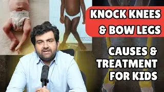 Understanding Normal Knee Alignment in Infants, Knock Knees, Bow Legs & Common Deformities Explained