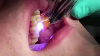 Dental Curing Light: SmartLite&reg; Focus&reg; vs Ivoclar BluePhase