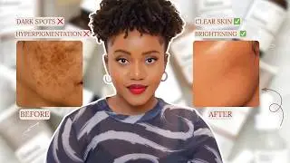 How to Use The Ordinary Products | Reduce Hyperpigmentation & RosaceaFlare ups