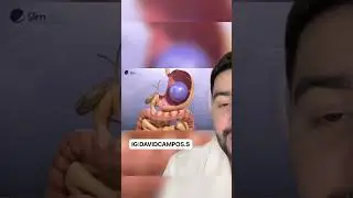BAL&Oacute;N G&Aacute;STRICO PARA ADELGAZAR