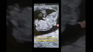 Acrania before 9 week gestation age #rare diagnosis #sonography