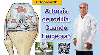 Knee osteoarthritis: When does it get worse?