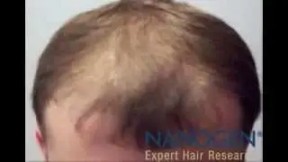 NANOGEN - Gęste Włosy w 30 Sekund !