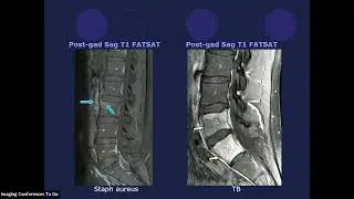 Spine Imaging -  Spine Infection Tips For Radiologists