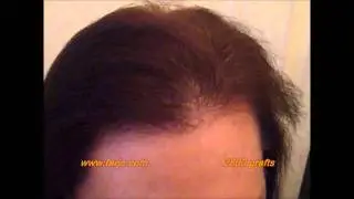 Anna-Dawn Transgender hair transplant surgery video result with narration