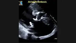 Atrial Thrombosis #shorts