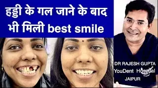 चेहरे कि हड्डी गल जाने के बाद भी फ़िक्स दाँत लगवा सकते है YOUDENT HOSPITAL JAIPUR. 8233792911